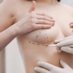 Phẫu thuật nâng ngực