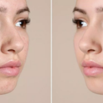 trị mụn tại các spa