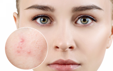Top 10 spa tri mun uy tín, chất lượng nhất hiện nay Top 10 spa tri mun uy tín, chất lượng nhất hiện nay