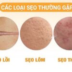 sẹo lõm, lồi, thâm đỏ