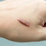 Hình ảnh sẹo lồi