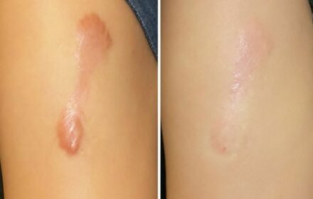 Tiêm sẹo lồi có an toàn không? Tiêm bao lâu thì xẹp Tiêm sẹo lồi có an toàn không? Tiêm bao lâu thì xẹp