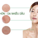 Da nhờn, da nhiều dầu