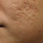 Sẹo lõm thủy đậu