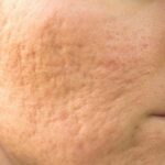 Sẹo rỗ trên mặt