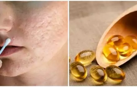 Cách trị sẹo rỗ mụn cực hiệu quả không phải ai cũng biết Cách trị sẹo rỗ mụn cực hiệu quả không phải ai cũng biết
