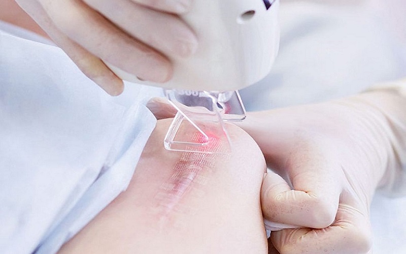 Laser là sẹo