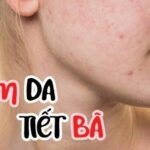 Viêm da tiết bã