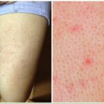 Viêm lỗ chân lông