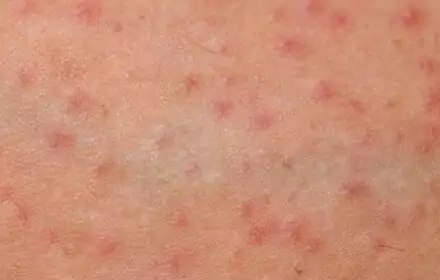 7 cách trị viêm lỗ chân lông đơn giản, nhanh chóng, hiệu quả 7 cách trị viêm lỗ chân lông đơn giản, nhanh chóng, hiệu quả