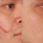 Xóa sẹo khâu trên mặt