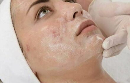 Cách xóa sẹo khâu trên mặt vĩnh viễn Cách xóa sẹo khâu trên mặt vĩnh viễn