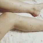 sẹo thâm xuất hiện ở chân