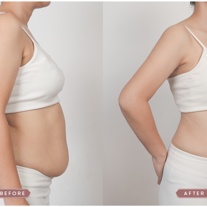 Giảm ngay 15cm vòng eo với công nghệ giảm mỡ hiện đại
