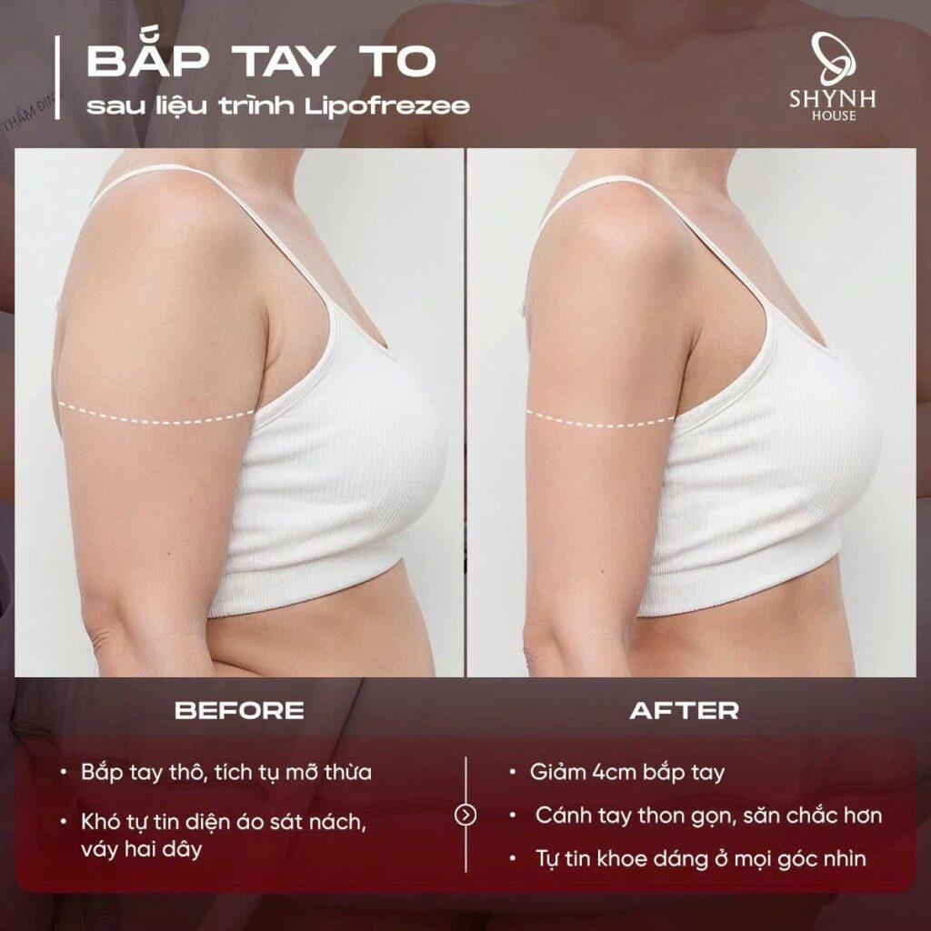 Khách hàng thực hiện dịch vụ giảm béo Lipofreeze tại Shynh House