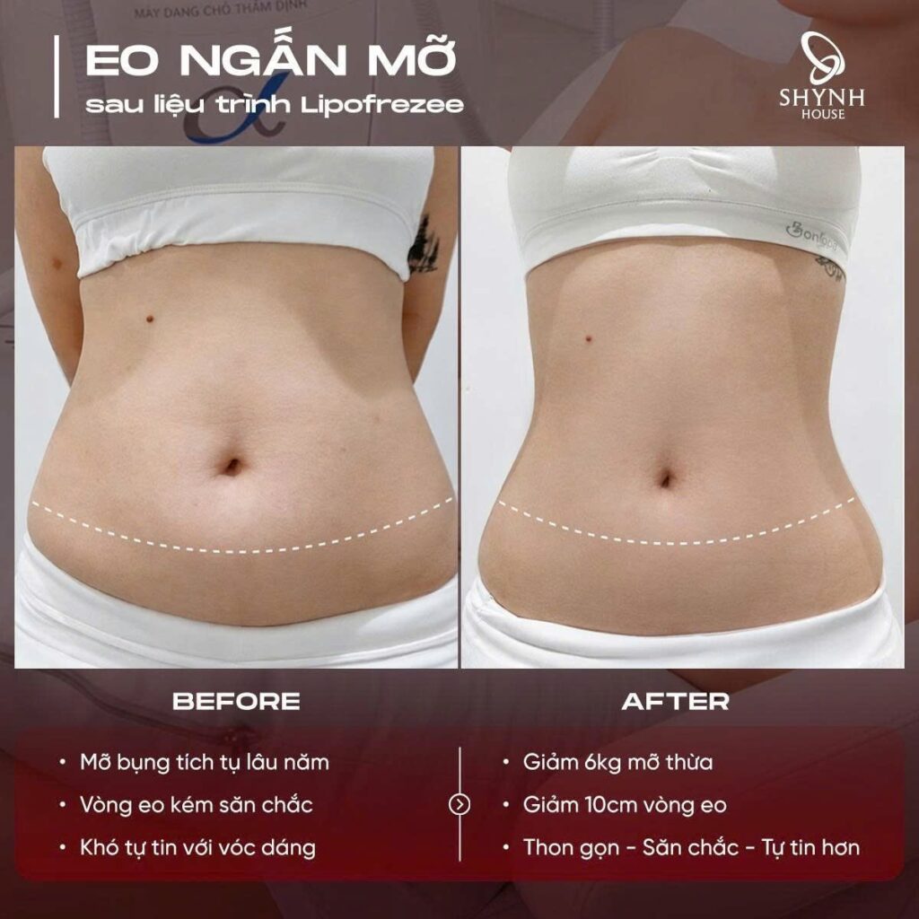 Khách hàng thực hiện dịch vụ giảm béo Lipofreeze tại Shynh House
