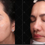 Bắn laser trị nám tại Shynh House có hiệu quả không