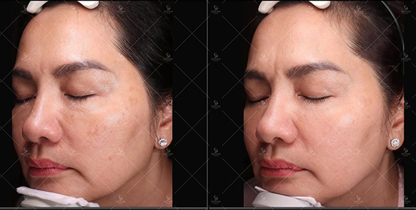 Bắn laser trị nám tại Shynh House có hiệu quả không