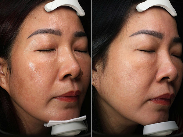 Quá trình bắn laser trị nám tác động trực tiếp vào vùng da bị tăng sắc tố melanin
