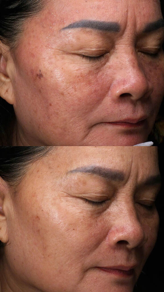 Laser trị nám giúp phá vỡ các hắc sắc tố melanin và hỗ trợ cơ thể đào thải sắc tố tự nhiên