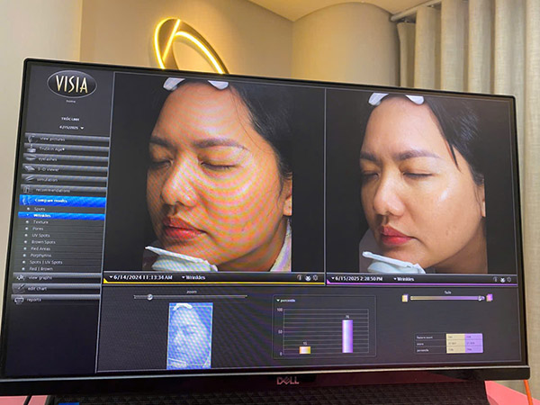 Bác sĩ da liễu thăm khám và đánh giá tình trạng da trước khi bắn laser trị nám