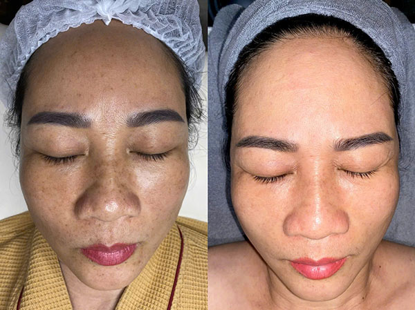 Khách hàng được soi da để xác định có nên bắn laser trị nám hay không