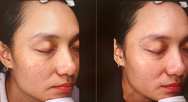Tìm hiểu nhược điểm của phương pháp bắn laser trị nám trong điều trị sắc tố da