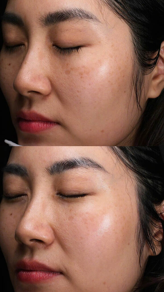 Quy trình bắn laser trị nám được thực hiện theo chuẩn y khoa tại Shynh House