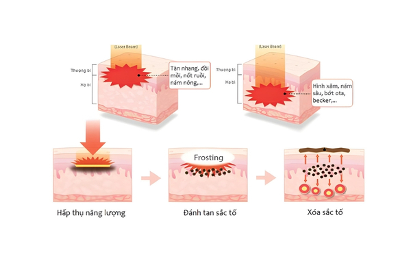 Cơ chế của phương pháp bắn laser trị thâm