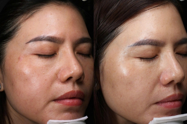 Phương pháp bắn laser trị thâm giúp da đều màu, tăng sinh collagen