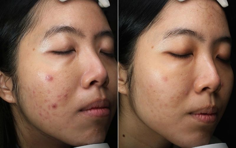 Liệu trình peel da trị mụn chuẩn y khoa hiệu quả