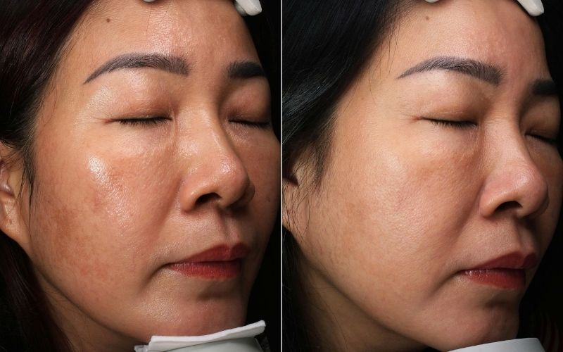 Khoảng cách giữa các buổi peel da trị lão hóa sâu