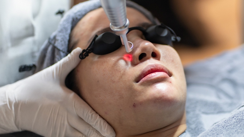 Cách chăm sóc da sau khi bắn laser trị nám theo từng giai đoạn