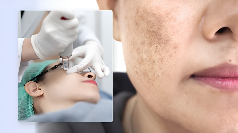 Chăm sóc da đúng cách sau laser trị nám giúp hỗ trợ quá trình tái tạo da