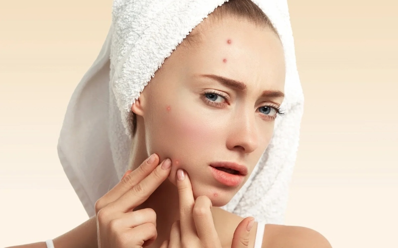 Có thể lấy nhân mụn không cần nặn không?