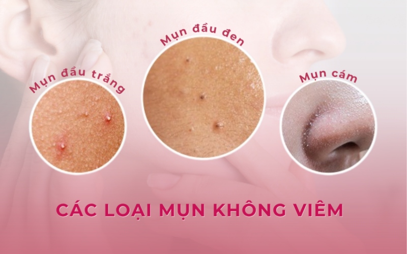 Mụn đầu đen, mụn đầu trắng và mụn cám có thể tự lấy nhân
