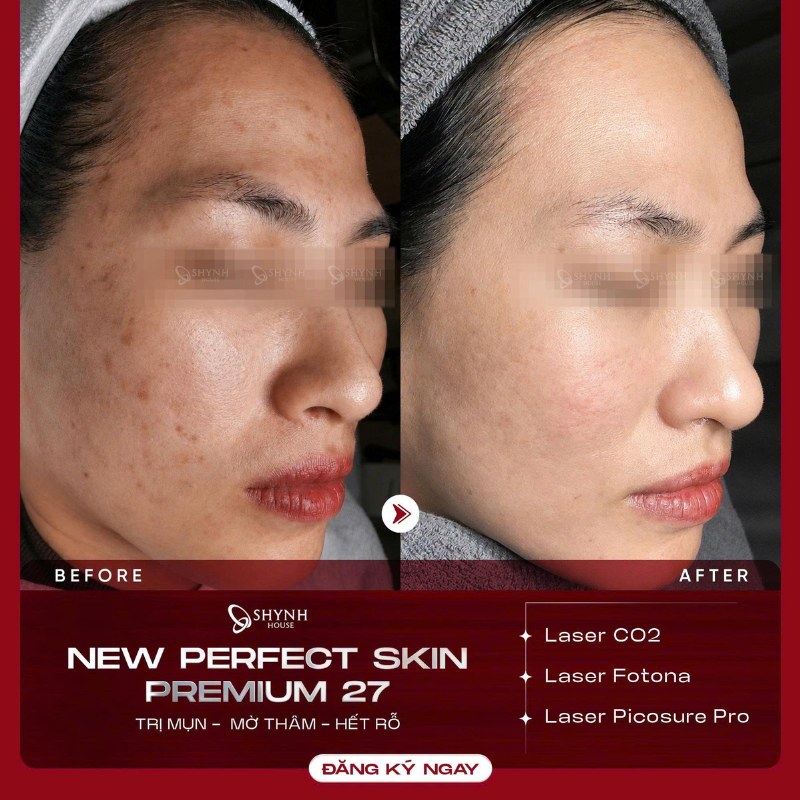 Điều trị mụn bằng laser giúp giảm viêm, kiểm soát bã nhờn