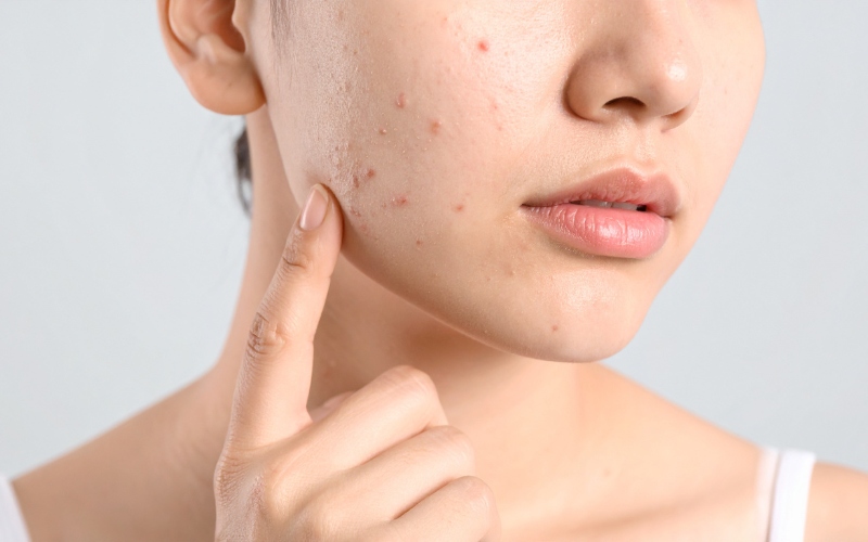 Chỉ nặn khi mụn đã hết sưng đau, cồi khô lại và trồi rõ lên bề mặt da