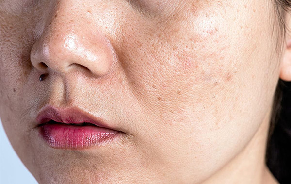 Làn da lão hóa giảm collagen và elastin khiến bề mặt da kém săn chắc và lỗ chân lông to hơn