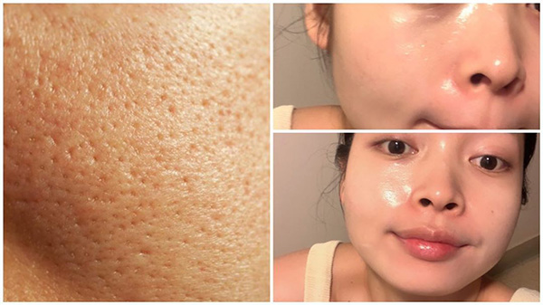 Dưỡng ẩm đúng cách giúp cân bằng dầu nước và hạn chế tình trạng lỗ chân lông giãn rộng