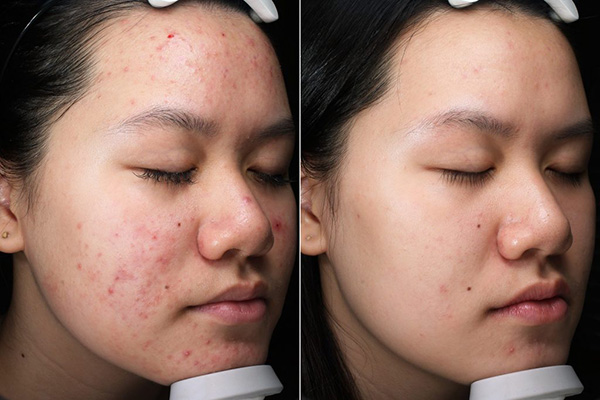 Hiệu quả thực tế của cách trị mụn ẩn bằng nghệ đối với làn da