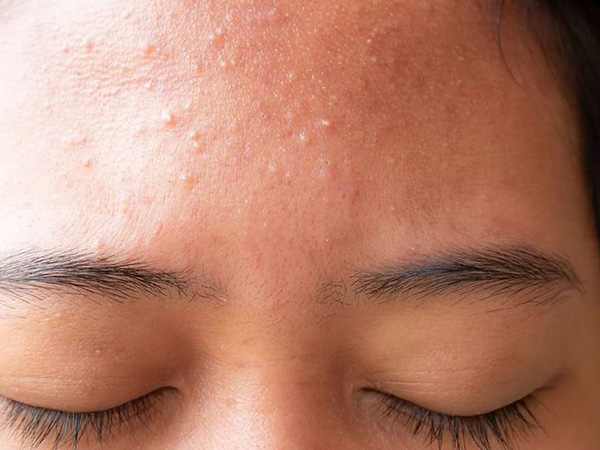 Mụn ẩn trên trán khiến bề mặt da sần sùi và kém thẩm mỹ