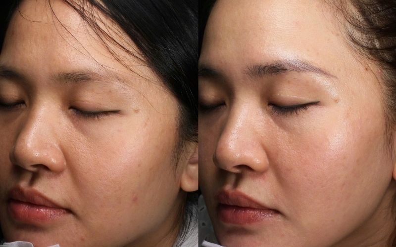 Chăm sóc da sau khi peel rất cần thiết để giúp da phục hồi nhanh