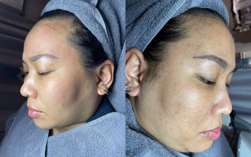 Các bước phục hồi da an toàn trong mười bốn ngày đầu