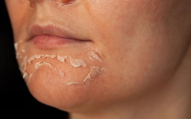 Tạm ngưng hoạt chất mạnh khi da đang tái tạo sau peel