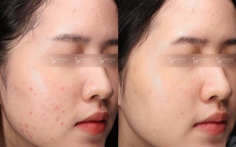 Xác định tình trạng da phù hợp trước khi quyết định peel