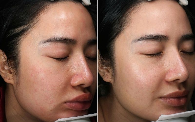 Phương pháp peel da giúp làm đều màu và giảm thâm nám