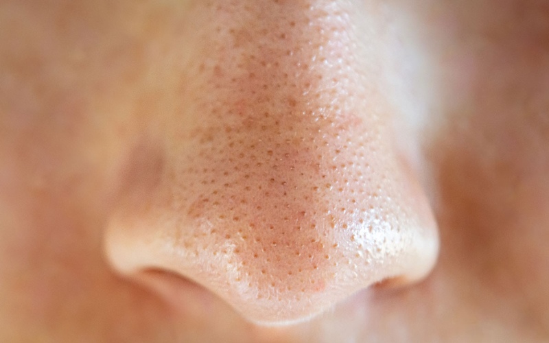 Khi da được làm sạch đúng cách, mụn không viêm có thể tự khô rồi bong đi