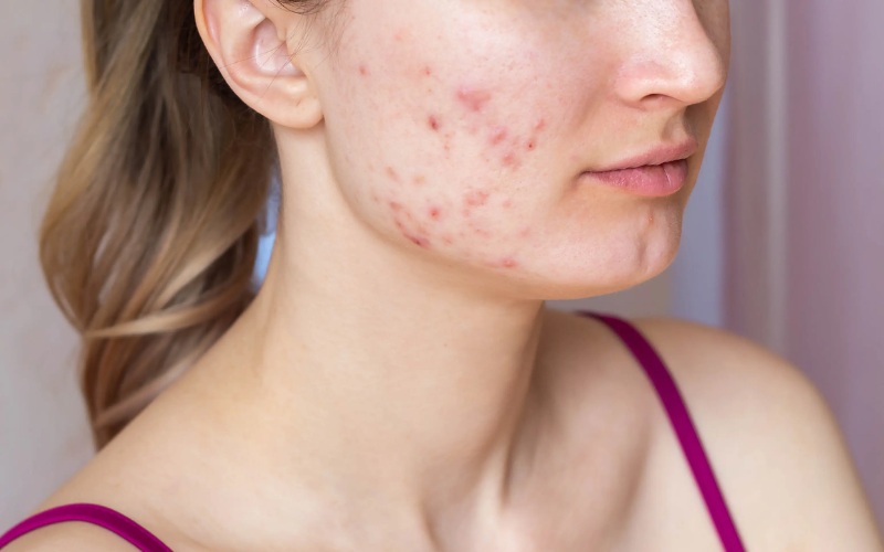 Mụn viêm sưng đỏ cần can thiệp lấy nhân chuẩn y khoa
