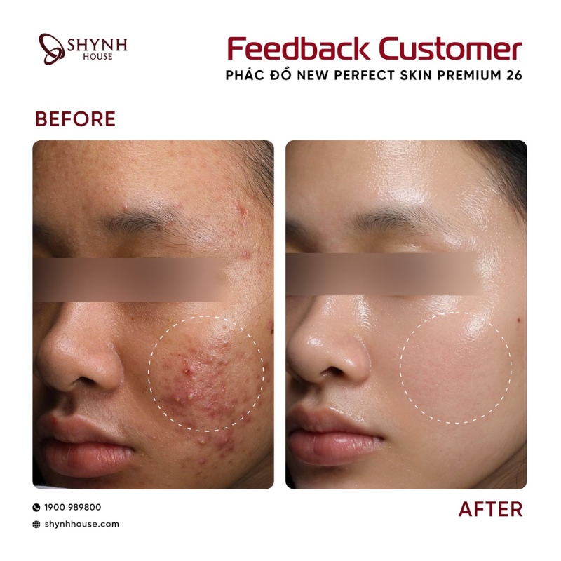 Tình trạng mụn viêm cần có phác đồ điều trị, không thể chờ tự hết